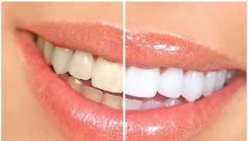 Teeth-Whitening