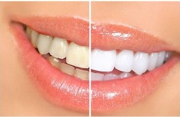 Teeth-Whitening