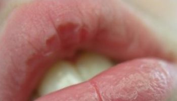 chapped-lips
