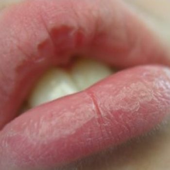 chapped-lips