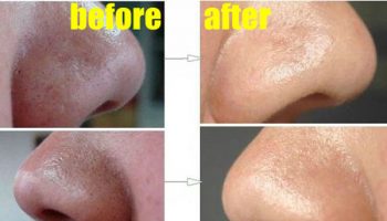 How to Easily Remove Deep Blackheads