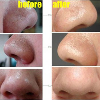 How to Easily Remove Deep Blackheads