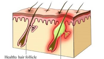 folliculitus Ingrown Hair Removal Scrub