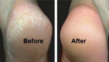 Home-Heel-Crack-Remedy