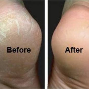 Home-Heel-Crack-Remedy
