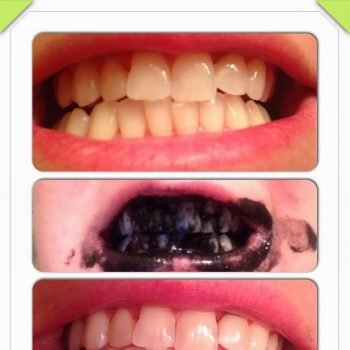 How to Naturally Whiten Your Teeth – DIY