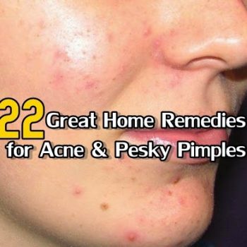 22 Great Home Remedies for Acne & Pesky Pimples