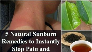 Natural Sunburn Pain Remedies and Peeling Prevention
