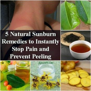 Natural Sunburn Pain Remedies and Peeling Prevention