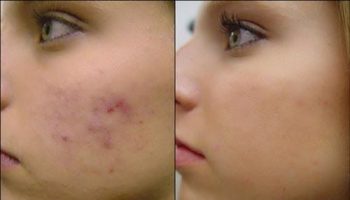 Smooth Skin Trick