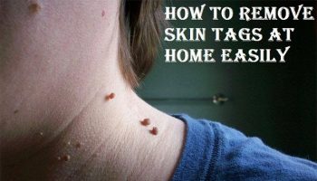 how-to-remove-skin-tags-at-home