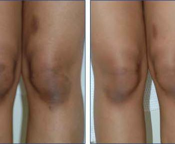 Get-rid-of-dark-knees-and-elbows