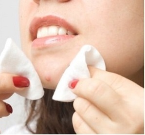 No Scars Pimple Removing Method