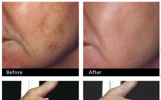 age-spots
