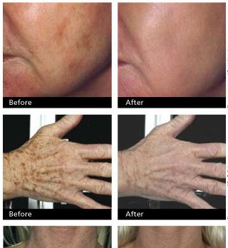 age-spots