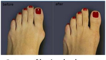 bunions.jpg