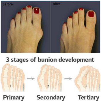 bunions.jpg