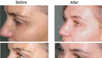 Myths About Facelifting Uncovered