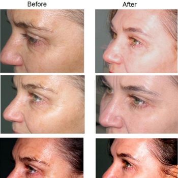 Myths About Facelifting Uncovered