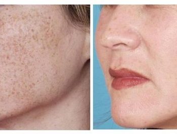 How To Naturally Lighten Freckles