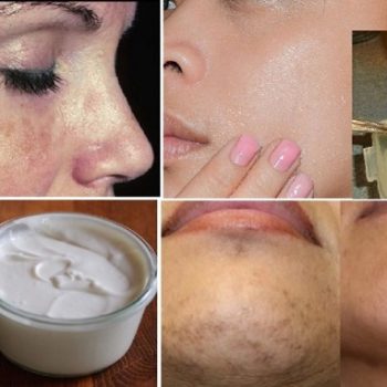Awesome Home Remedies For Black Spots