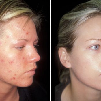 Tips On How to Hide Acne On Face