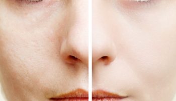 Woman with spotty skin with deep pores  and healed soft skin