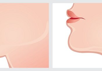 double chin before and after