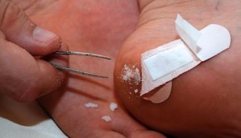 8 Ways To Remove a Hurtful Splinter