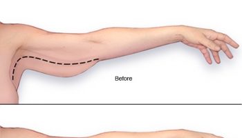 Arm-Reduction