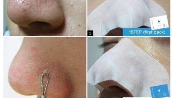 How To Remove Blackheads And Whiteheads With Skinmiso Kit (2)