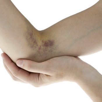How To Get Rid Of Bruises Fast And Easy (2)