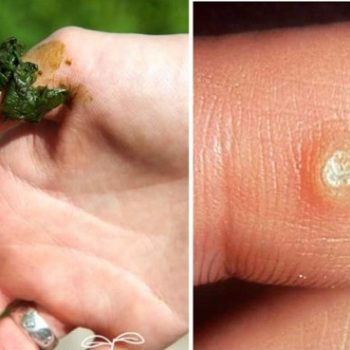 How To Get Rid Of Warts With Home Remedies