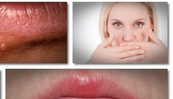 how-to-treat-herpes-get-rid-of-herpes-can