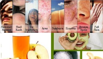 Natural Home Remedies For Summer Skin Problems