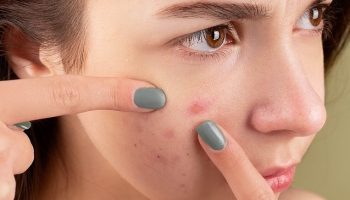acne treatment 1