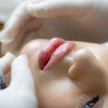 dermal fillers